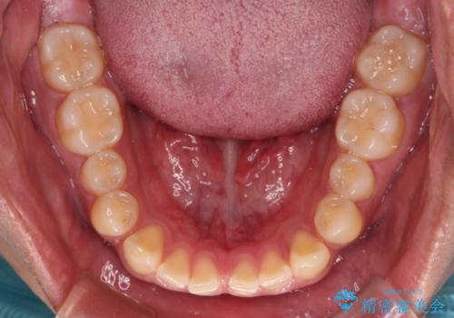 隙間だらけの歯列を治したい ワイヤー矯正での矯正治療の治療前