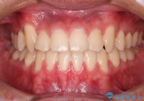 【審美装置】前歯の反対咬合改善の症例 治療後