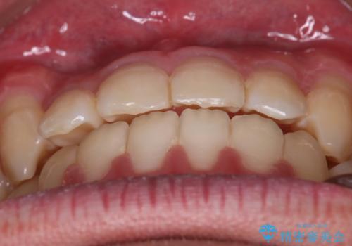 【審美装置】前歯の反対咬合改善の治療後