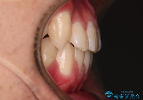 【審美装置】前歯の反対咬合改善の治療後