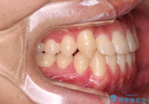 【審美装置】前歯の反対咬合改善の治療後