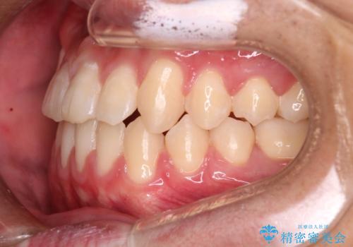 【審美装置】前歯の反対咬合改善の治療後