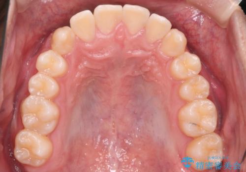 【審美装置】前歯の反対咬合改善の治療後