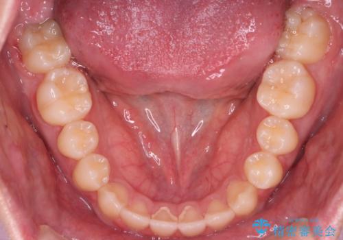 【審美装置】前歯の反対咬合改善の治療後