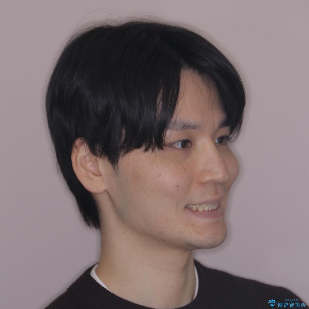 【モニター】八重歯とデコボコを治したい 補助装置を併用したワイヤー矯正の治療後(顔貌)