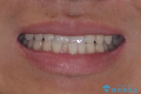 前歯のガタガタ・奥歯のかみ合わせ(シザーズバイト)を改善|1年半で完了したメタルブラケット矯正の治療前(顔貌)