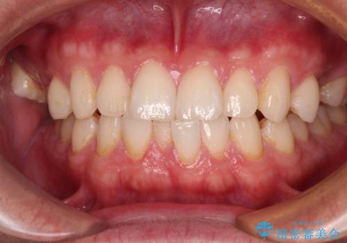 前歯のガタガタ・奥歯のかみ合わせ(シザーズバイト)を改善|1年半で完了したメタルブラケット矯正の治療前