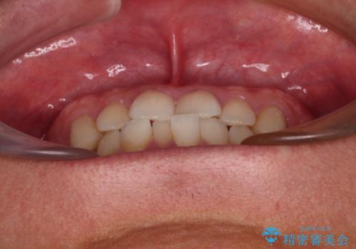 前歯のガタガタ・奥歯のかみ合わせ(シザーズバイト)を改善|1年半で完了したメタルブラケット矯正の治療前