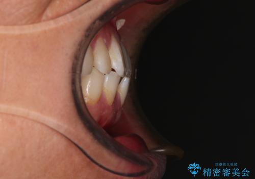 前歯のガタガタ・奥歯のかみ合わせ(シザーズバイト)を改善|1年半で完了したメタルブラケット矯正の治療前