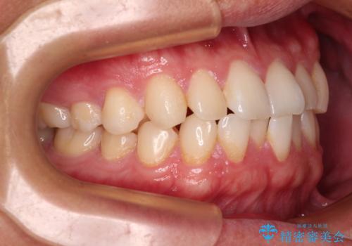 前歯のガタガタ・奥歯のかみ合わせ(シザーズバイト)を改善|1年半で完了したメタルブラケット矯正の治療前