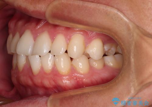 前歯のガタガタ・奥歯のかみ合わせ(シザーズバイト)を改善|1年半で完了したメタルブラケット矯正の治療前