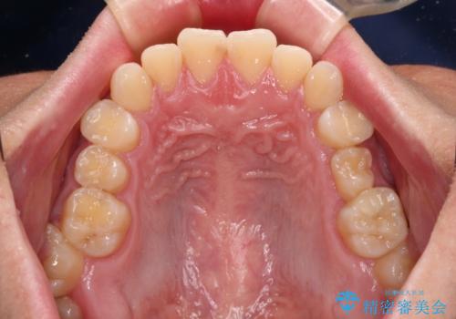 前歯のガタガタ・奥歯のかみ合わせ(シザーズバイト)を改善|1年半で完了したメタルブラケット矯正の治療前