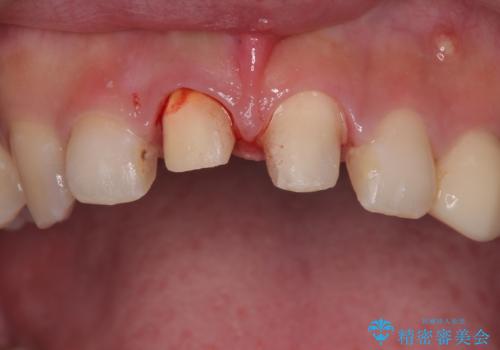 「抜歯してブリッジ」と言われた20代女性が選んだ治療とは?|たった4か月で自然な笑顔に|抜歯即時インプラント+審美補綴の症例の治療前
