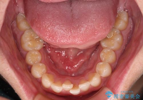 前歯のガタガタ・奥歯のかみ合わせ(シザーズバイト)を改善|1年半で完了したメタルブラケット矯正の治療前