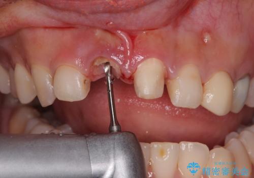 「抜歯してブリッジ」と言われた20代女性が選んだ治療とは?|たった4か月で自然な笑顔に|抜歯即時インプラント+審美補綴の症例の治療中