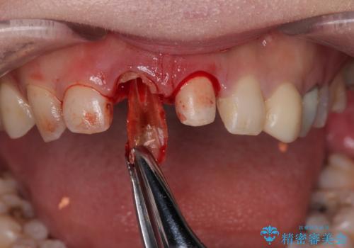 「抜歯してブリッジ」と言われた20代女性が選んだ治療とは?|たった4か月で自然な笑顔に|抜歯即時インプラント+審美補綴の症例の治療後