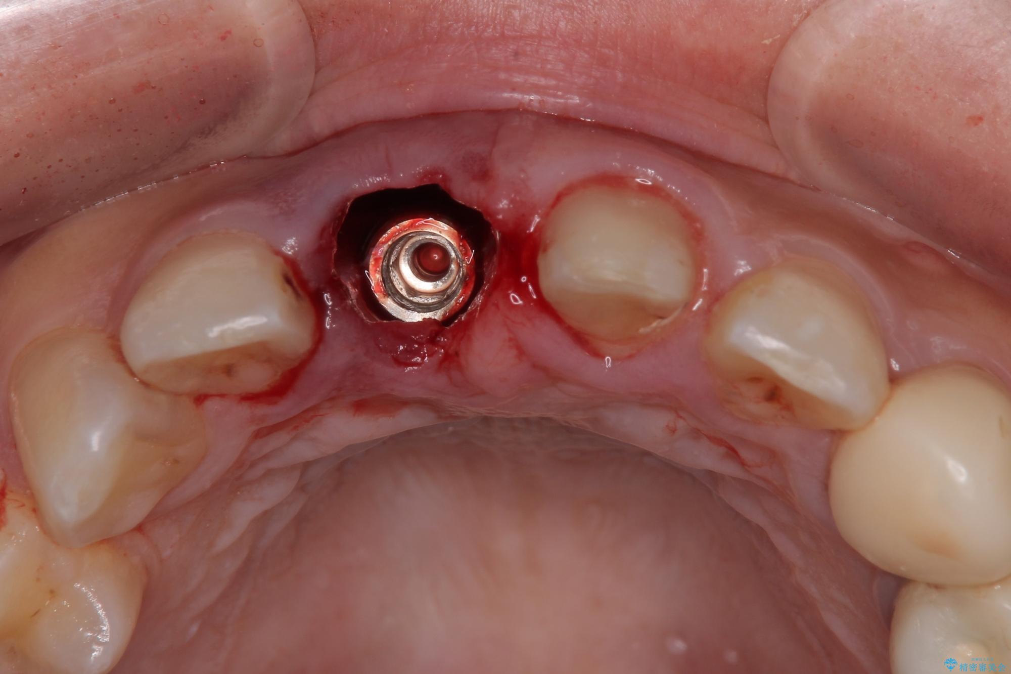 審美領域の抜歯即時埋入 成功の法則 一10年の軌跡から一 抜歯してブリッジ」と言われた20代女性が選んだ治療とは?|たった