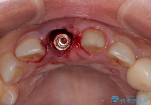 「抜歯してブリッジ」と言われた20代女性が選んだ治療とは?|たった4か月で自然な笑顔に|抜歯即時インプラント+審美補綴の症例の治療前