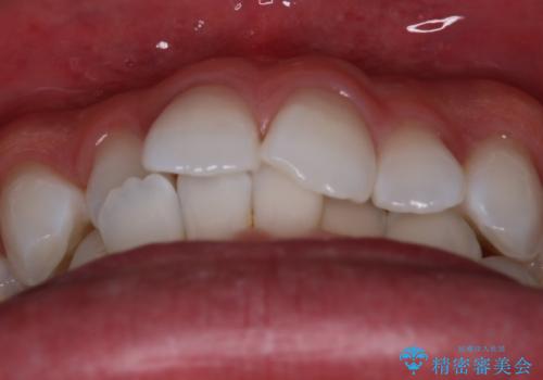 【インビザラインモニター】費用を抑えて歯並び改善!の治療前
