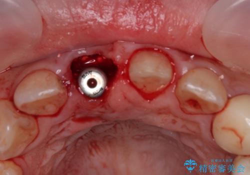 「抜歯してブリッジ」と言われた20代女性が選んだ治療とは?|たった4か月で自然な笑顔に|抜歯即時インプラント+審美補綴の症例の治療中