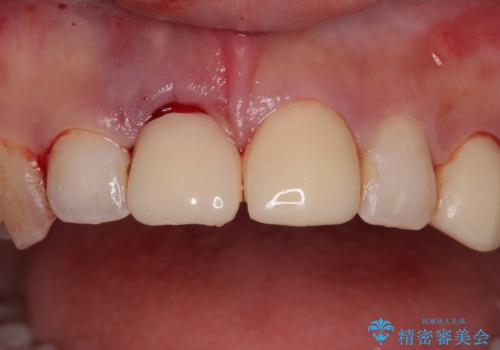 「抜歯してブリッジ」と言われた20代女性が選んだ治療とは?|たった4か月で自然な笑顔に|抜歯即時インプラント+審美補綴の症例の治療後