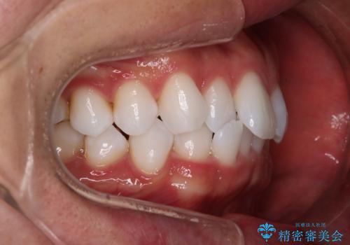 【インビザラインモニター】費用を抑えて歯並び改善!の治療前