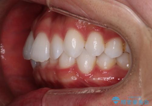 【インビザラインモニター】費用を抑えて歯並び改善!の治療前