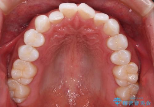 【インビザラインモニター】費用を抑えて歯並び改善!の治療前