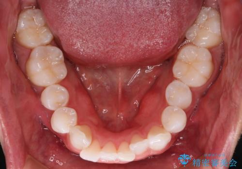 【インビザラインモニター】費用を抑えて歯並び改善!の治療前