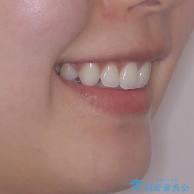 膨らんだ口元を改善する抜歯矯正 インプラント治療も同時に行う総合歯科治療の治療後(顔貌)