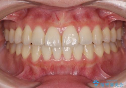 前歯のねじれ 矯正治療による歯並び改善