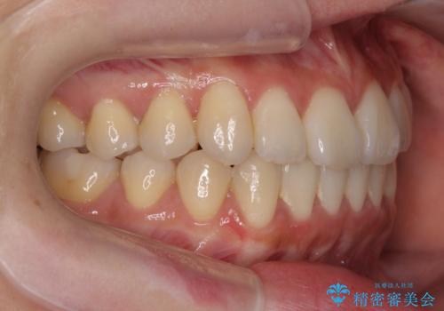 前歯のねじれ 矯正治療による歯並び改善の治療後