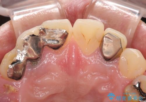 放置した破折歯 即時・早期のインプラント埋入による補綴治療の治療前