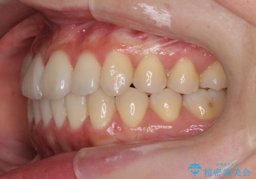 前歯のねじれ 矯正治療による歯並び改善の治療後