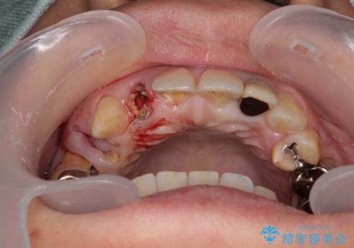 放置した破折歯 即時・早期のインプラント埋入による補綴治療の治療中