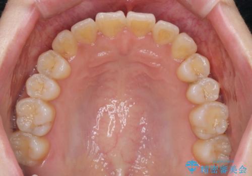 前歯のねじれ 矯正治療による歯並び改善の治療後