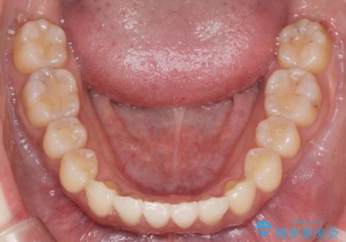 前歯のねじれ 矯正治療による歯並び改善の治療後