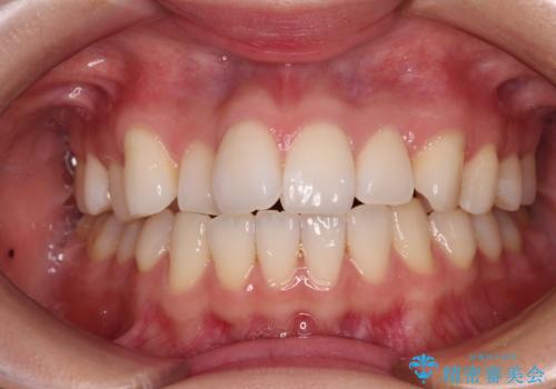 前歯のデコボコと口元の膨らみを治したい ワイヤー装置での非抜歯矯正の症例 治療前