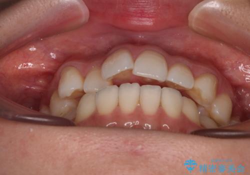 前歯のデコボコと口元の膨らみを治したい ワイヤー装置での非抜歯矯正の治療前