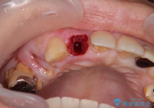 放置した破折歯 即時・早期のインプラント埋入による補綴治療の治療後