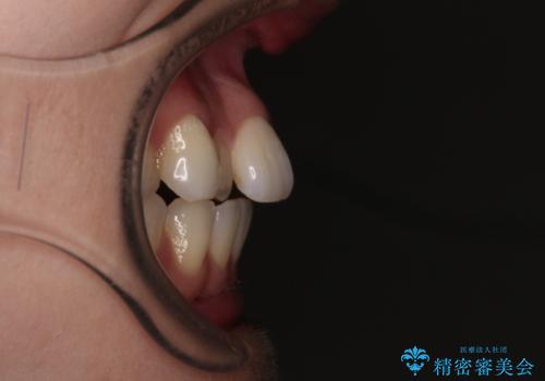 前歯のデコボコと口元の膨らみを治したい ワイヤー装置での非抜歯矯正の治療前