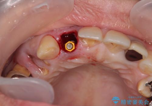 放置した破折歯 即時・早期のインプラント埋入による補綴治療の治療前