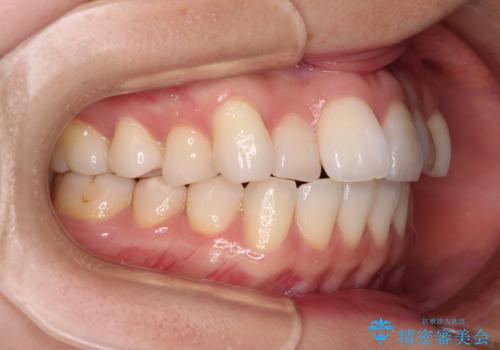 前歯のデコボコと口元の膨らみを治したい ワイヤー装置での非抜歯矯正の治療前