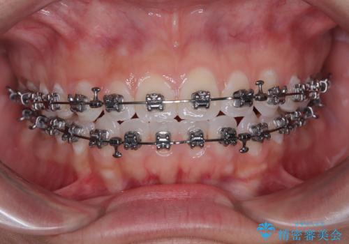 【モニター】マウスピース矯正が煩わしい ワイヤー装置での非抜歯矯正の治療中
