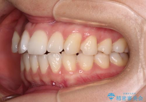 前歯のデコボコと口元の膨らみを治したい ワイヤー装置での非抜歯矯正の治療前