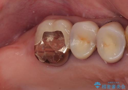 食事が取れないほどの激痛 奥歯のインプラント治療の治療中