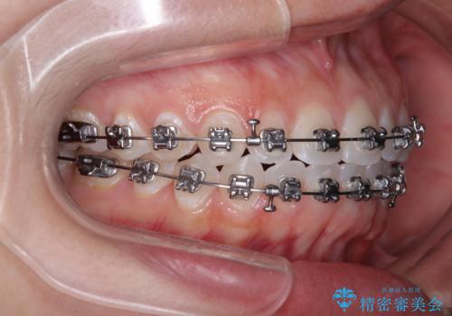 【モニター】マウスピース矯正が煩わしい ワイヤー装置での非抜歯矯正の治療中