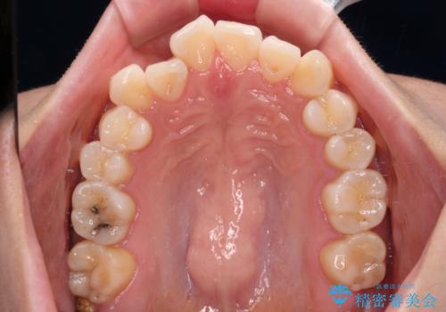 前歯のデコボコと口元の膨らみを治したい ワイヤー装置での非抜歯矯正の治療前