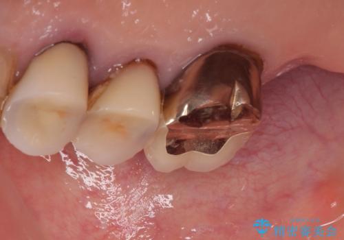 食事が取れないほどの激痛 奥歯のインプラント治療の治療中