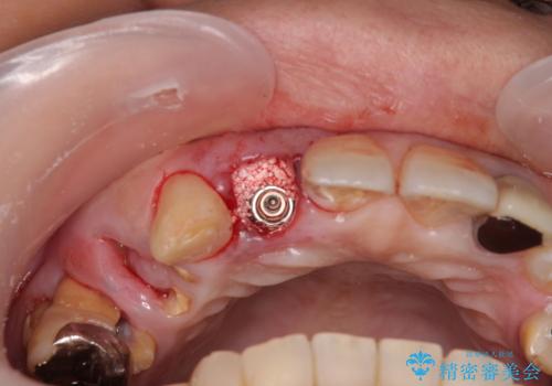放置した破折歯 即時・早期のインプラント埋入による補綴治療の治療中
